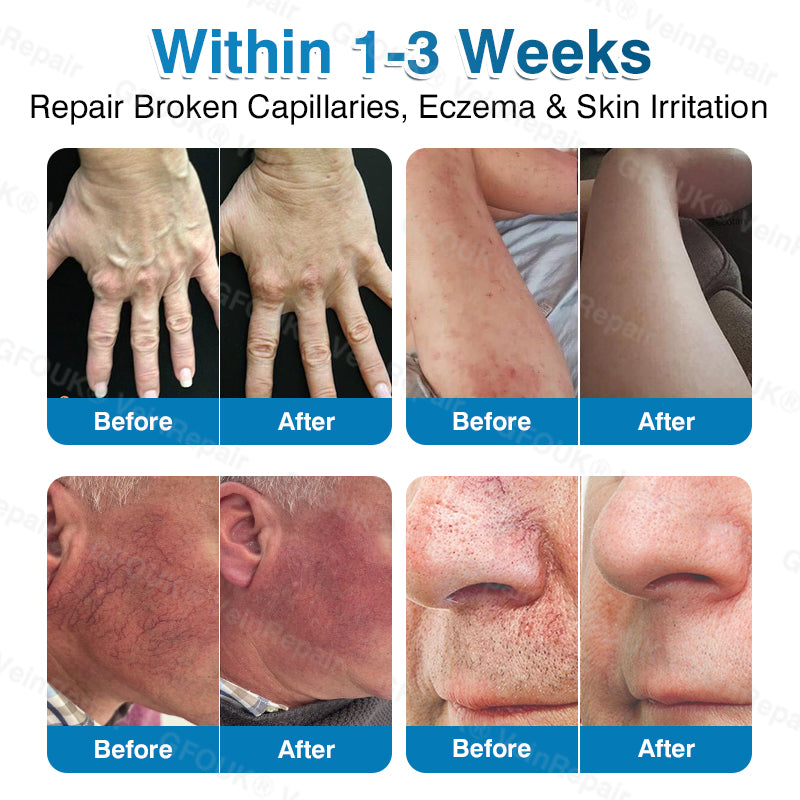 🏆🏃GFOUK® VeinRepair Microneedle Patch Roll⚡Instant Relief, Long-Term Results