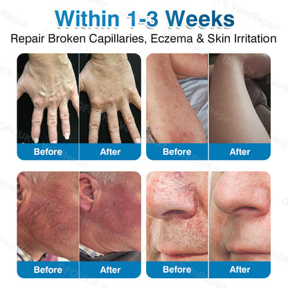 🏆🏃GFOUK® VeinRepair Microneedle Patch Roll⚡Instant Relief, Long-Term Results