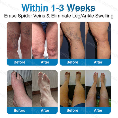 🏆🏃GFOUK® VeinRepair Microneedle Patch Roll⚡Instant Relief, Long-Term Results