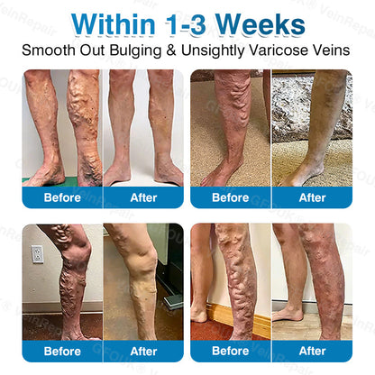 🏆🏃GFOUK® VeinRepair Microneedle Patch Roll⚡Instant Relief, Long-Term Results